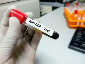 آزمایش آنتی بادی CCP 