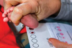 MLD در اواخر نوزادی