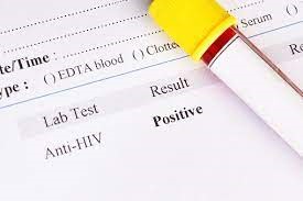 آزمایش ایدز مثبت