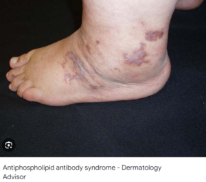 آنتی بادی بتا-2-گلیکوپروتئین 