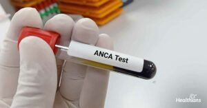 آزمایش ANCA 