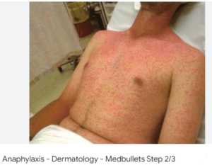 بالا رفتن هیستامین در بدن