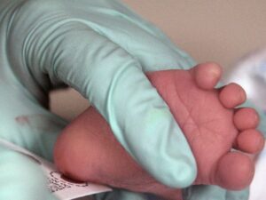 تشخیص فنیل کتونوری