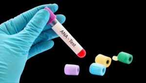 آنتی بادی ضد هسته ای 