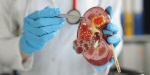 علائم نفریت لوپوس