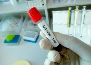 تست آلبومین گلوبولین