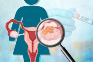 سطح نرمال CA125