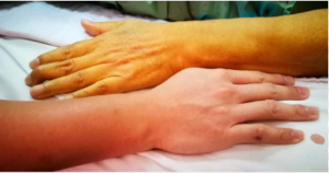 عوامل خطر فاویسم