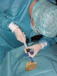 آسپیراسیون مغز استخوان