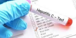 آزمایش Ab HCV