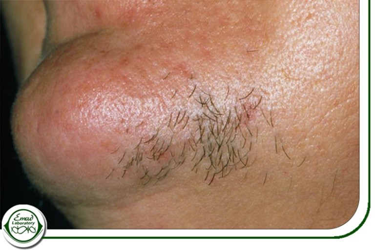 علائم افزایش تستوسترون در زنان