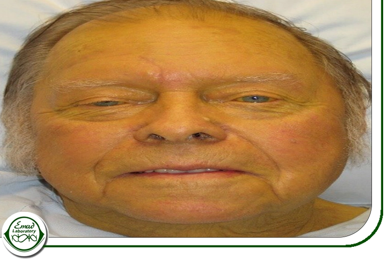 تشخیص بیماری های کبدی با تست بیلی روبین 1