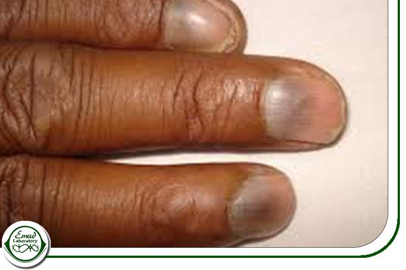 سرطان خون و رنگ ناخن