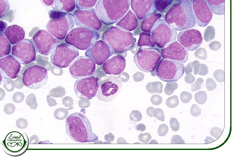 لوسمی میلوئیدی حاد (AML)