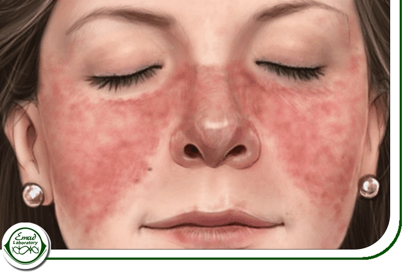 Systemic Lupus Erythematosus