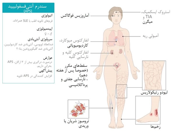 ارتباط با سندروم آنتی فسفولیپید