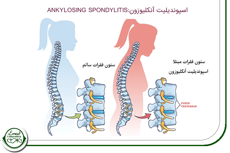 اسپوندیلیت آنکلیوزن 2
