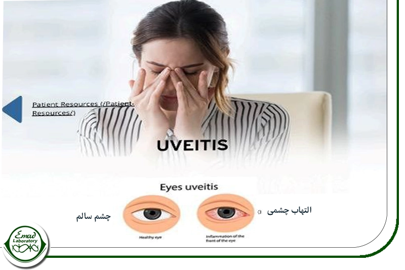 التهاب چشم