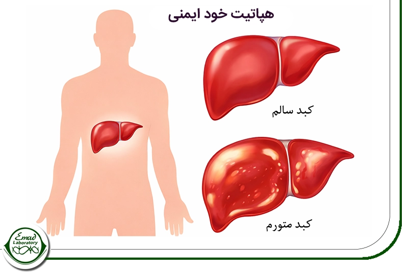 بیماری خودایمنی کبد