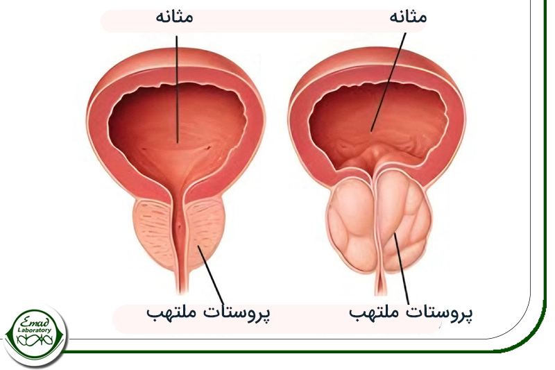 تشخیص بیماری های خوش خیم پروستات