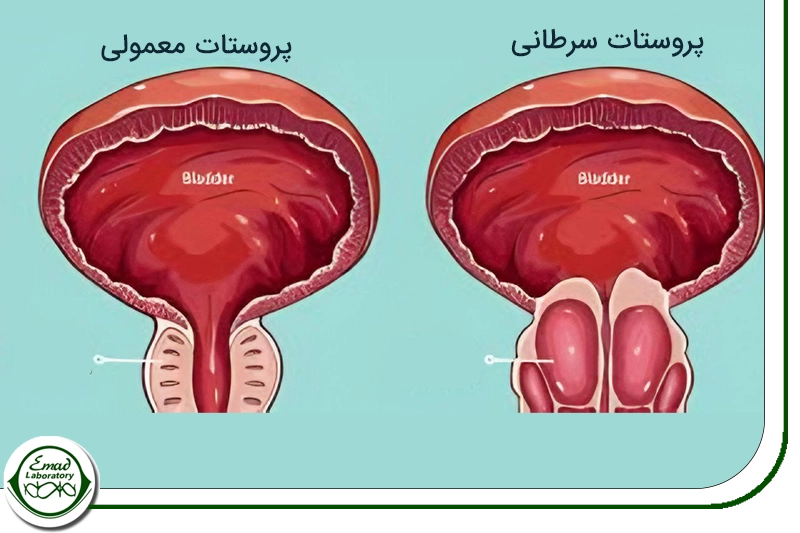 غربالگری سزطان