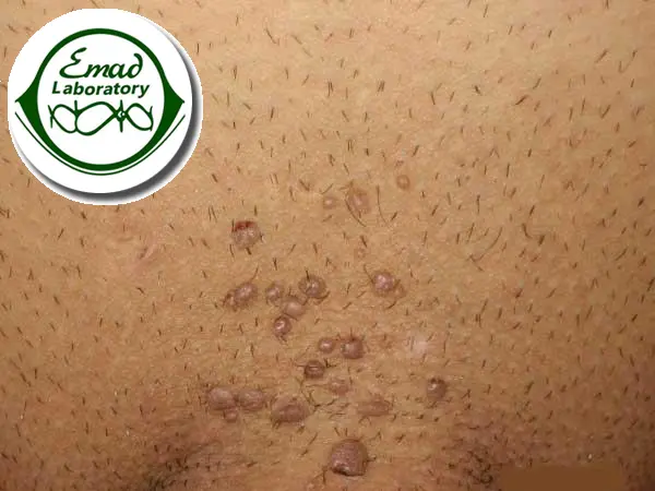 زگیل در مردان